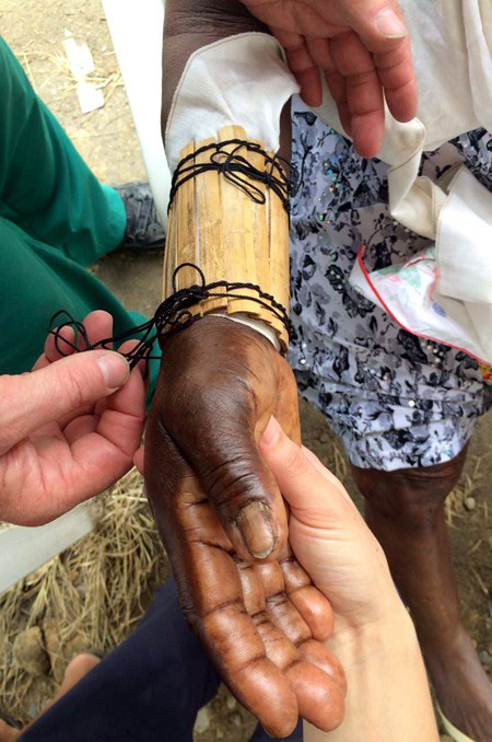 An 85-year-old woman arrived with an improvised bamboo splint on her fractured arm.
